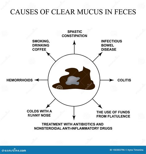 Causes of Clear Mucus in the Feces. Diseases of the Gastrointestinal ...