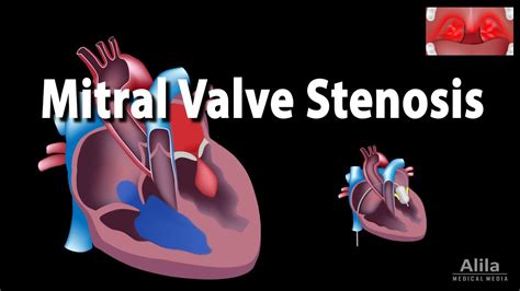 Mitral Valve Stenosis Pathophysiology