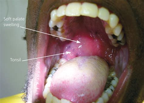 Peritonsillar Abscess | AAFP