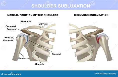 Shoulder Subluxation, Healthy Shoulder Joint And Shoulder Joint With Subluxation, Medical ...