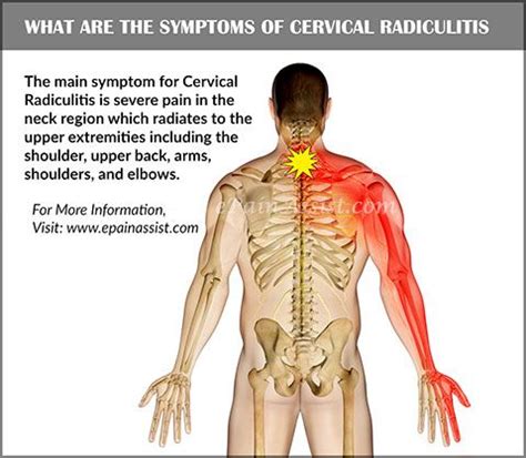 76 Best Of Can Spine Issues Cause Chest Pain - insectza