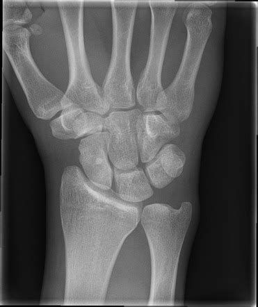 Occult scaphoid fracture | Radiology Case | Radiopaedia.org