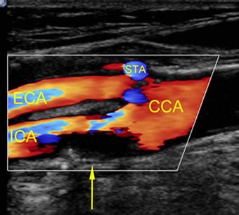 Carotid artery stenosis - Symptoms, diagnosis and treatment | BMJ Best Practice