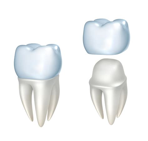 7 Things You Need to Know About Dental Crowns