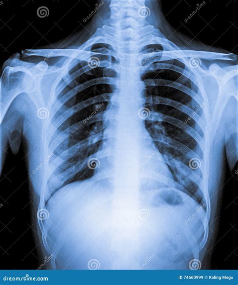 Normal Chest X Ray Images