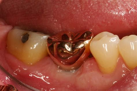 Gold Crowns - Advanced Dentistry & Dental Implant Center