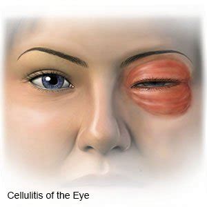 Periorbital Cellulitis in Adults - What You Need to Know