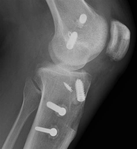 MCL and Posteromedial Corner | The Bone School