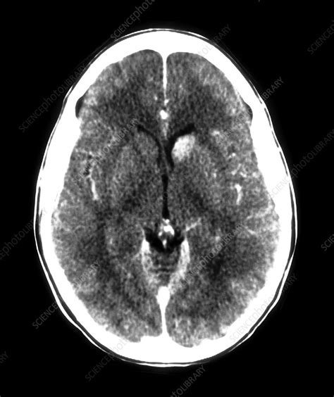 Capillary Telangiectasia Caudate Head - Stock Image - M136/0330 - Science Photo Library