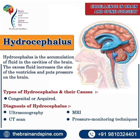 Hydrocephalus Hydrocephalus is the accumulation. of fluid in the cavities of the brain. The ...