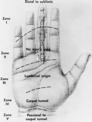 Flexor Tendon Zones of Hand | Bone and Spine