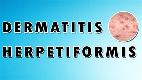 Celiac Disease Foundation Dermatitis Herpetiformis, Also, 59% OFF