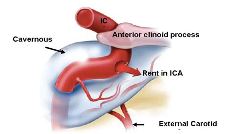 Carotid-Cavernous Fistula - Dr. Vivek Gupta