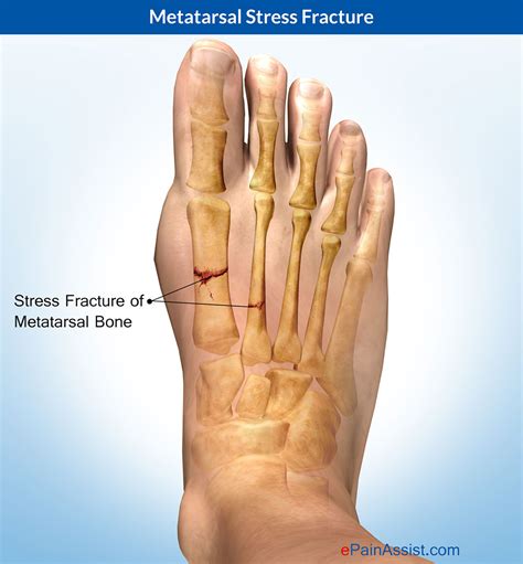 Metatarsal Stress Fracture: Treatment, Symptoms, Recovery, Causes