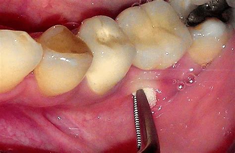 The 5 Abscess Tooth Stages and the Actions You Should Take