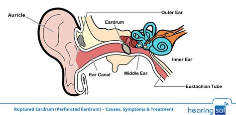 Ruptured Eardrum (Perforated Eardrum) - Know Best Treatment