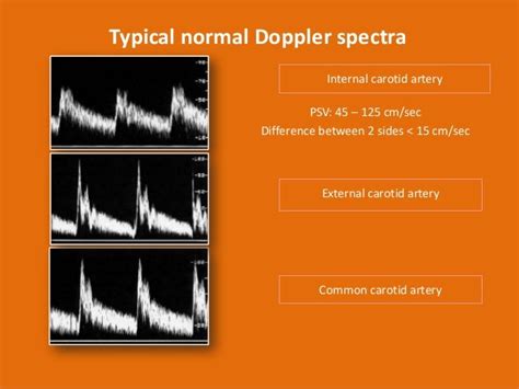 Carotid doppler ultrasound