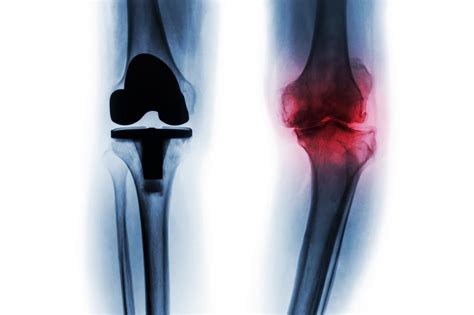 Medical Advancements and Technology in Total Knee Replacement Surgery