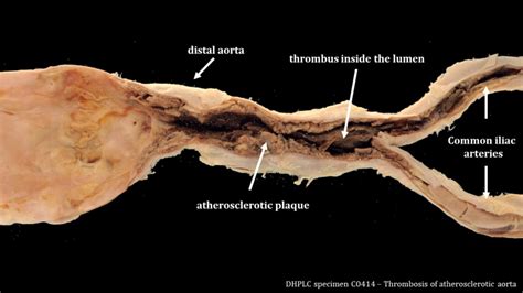 Gross Anatomy and Histopathology of Atherosclerosis – Pathology