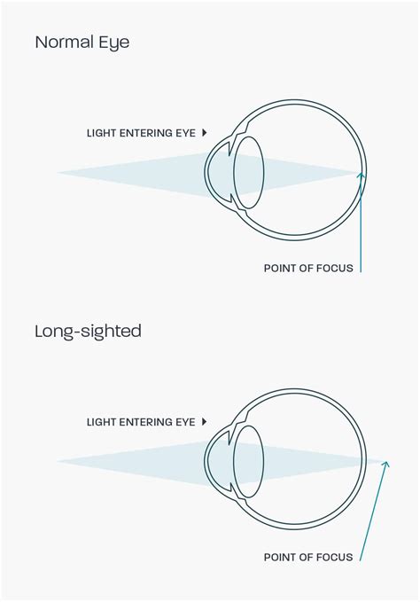 Hyperopia | Glasses Direct