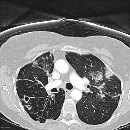 Mai Lung Disease Prognosis - Captions Profile