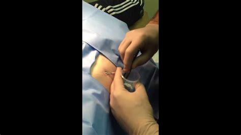 Testopel Insertion. Testosterone pellet treatment and trp o - YouTube