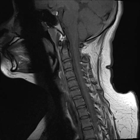 Hangman's fracture | Image | Radiopaedia.org