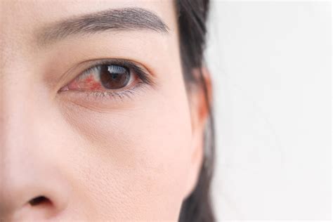 7 Pink Eye Symptoms You Shouldn't Ignore | The Healthy