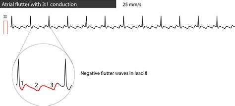 Atrial flutter: classification, causes, ECG diagnosis & management – ECG & ECHO