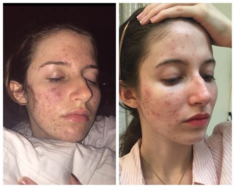 [Acne] Does Anyone Have Advice On How I Could Clear My Post Accutane Skin? : r/SkincareAddiction