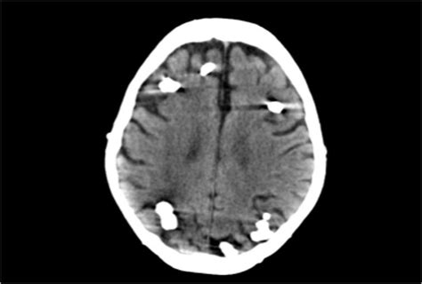 The Radiology Assistant : Brain - Epilepsy: Role of MRI