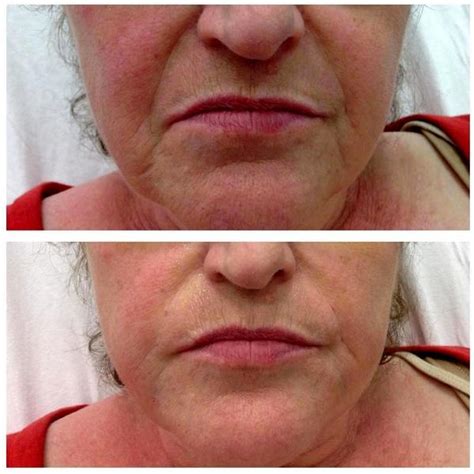 Marionette Lines Botox Before And After Pictures (1) » Facial Injections: Info, Prices, Photos ...