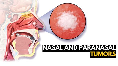 Can A Sinus Tumor Be Benign? Quick Answer - Ecurrencythailand.com