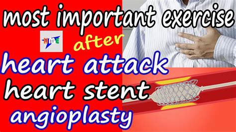 Most Important Exercise After Heart Attack Or Heart Stent Surgery Or ...