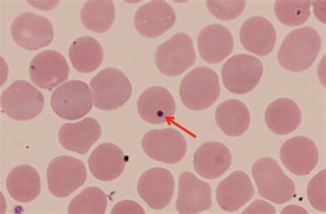 A Howell–Jolly body (marked by arrow) on peripheral blood smear (red... | Download Scientific ...