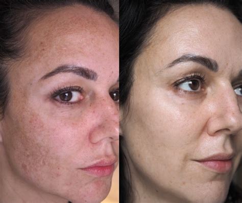 Can Hydroquinone Make My Melasma Worse?- Myths Busted