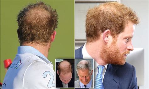 Prince Harry has a growing bald spot just like Charles and William ...