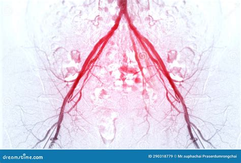 Femoral Artery Angiogram or Angiography Stock Image - Image of fluoroscopy, angiography: 290318779