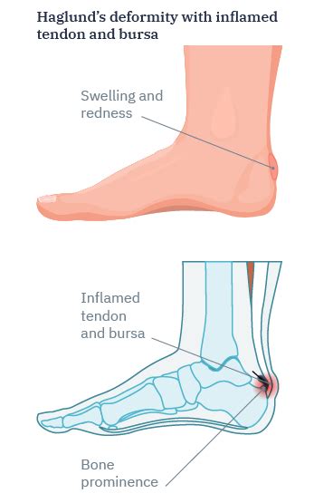 Haglund’s deformity causes, symptoms and treatment options