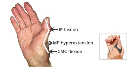 Z Line Deformity