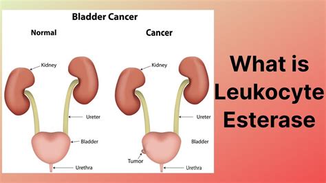 What is Leukocyte Esterase - YouTube