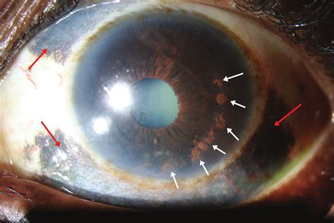 Conjunctival melanosis evident on slit-lamp examination in the left eye ...