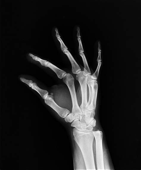 normal hand x ray - Captions Fortify