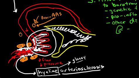 Pathophysiology of Hypertensive Nephropathy - YouTube