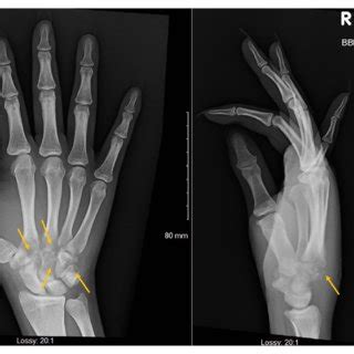 X-ray of right wrist showing interval progression of osteopenia and... | Download Scientific Diagram