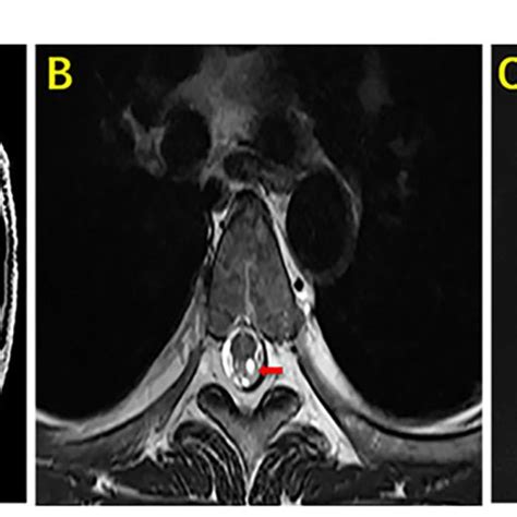 FIGURE E MRI of the brain and lumbar vertebra of our case. The sagittal ...