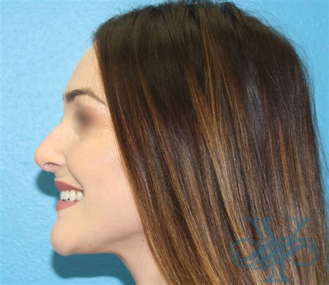 Rhinoplasty Case 3780 - Sara Yegiyants MD FACS