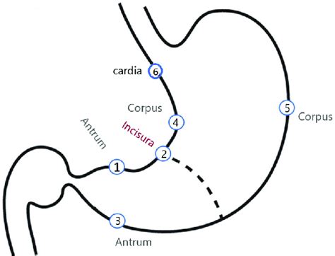 Biopsy Mapping. Biopsy Sites: 1: Antrim: Prepyloric, 2 cm of Pylorus,... | Download Scientific ...