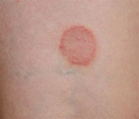 red circles rash - pictures, photos