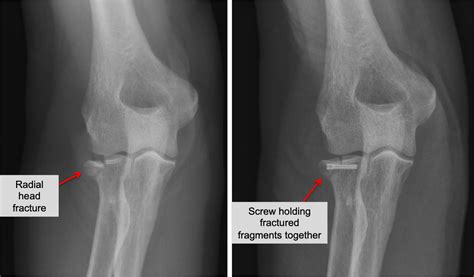 Radial Head Fracture — Joseph J. Schreiber, MD